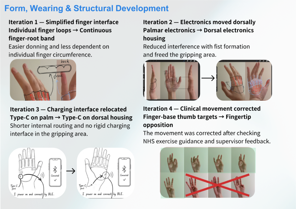 The design was refined through several iterations to simplify wearing, move electronics and charging dorsally, and correct the thumb interaction using clinical guidance and supervisor feedback.