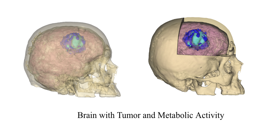 There are two images of a skull with a brain with a tumor. The skull on the right has a cross section taken out.