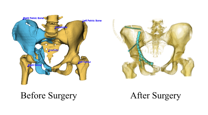On the left is an image of a fractured pelvis facing the front. On the right is an image of the fractured pelvis with metal implants after surgery.
