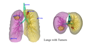 There are two images of a pair of lungs with two tumors. The image on the left is a front view and the image on the right is a top-down view.