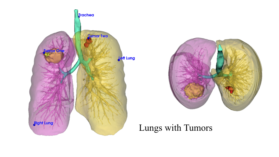 There are two images of a pair of lungs with two tumors. The image on the left is a front view and the image on the right is a top-down view.